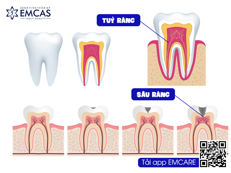 Những Trường Hợp Cần Phải Lấy Tủy Răng