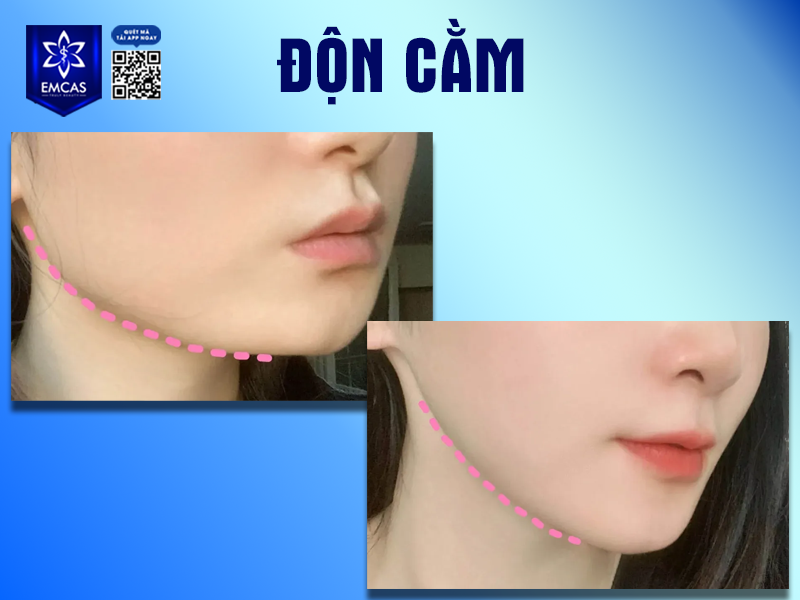 Những Yếu Tố Ảnh Hưởng Đến Kết Quả Độn Cằm