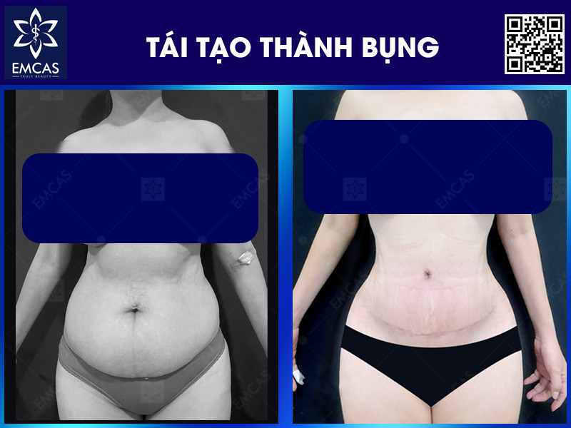 Tái tạo thành bụng