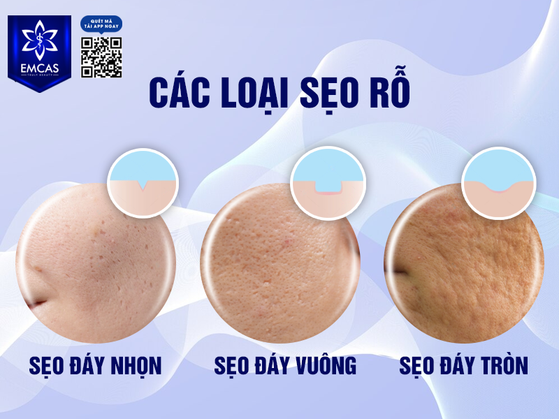 Sẹo Rỗ Là Gì? Nguyên Nhân Hình Thành Sẹo Rỗ?