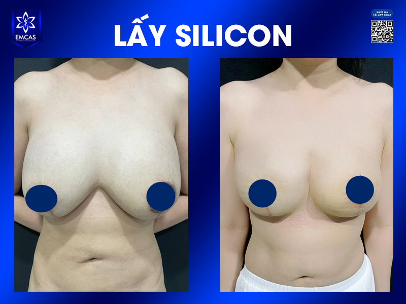 Tác Hại Khôn Lường Của Việc Nâng Ngực Bằng Silicone