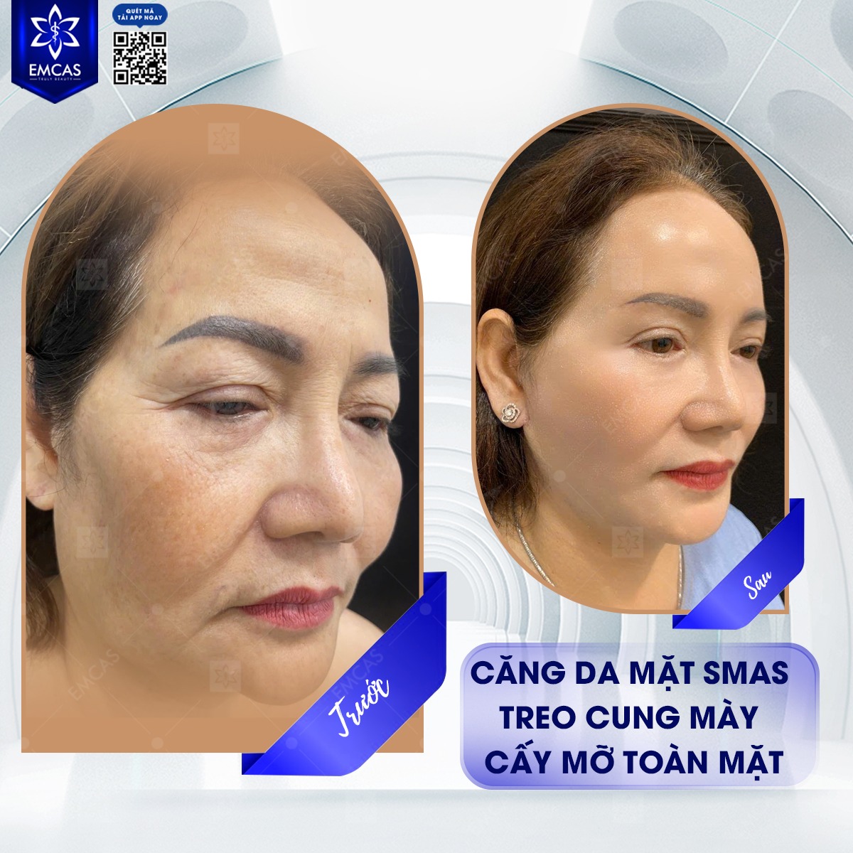 Phẫu Thuật Căng Da Mặt Có Đau Không?