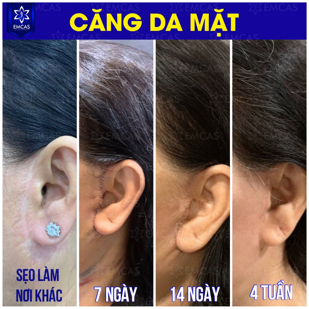 Phẫu Thuật Căng Da Mặt Có Đau Không?