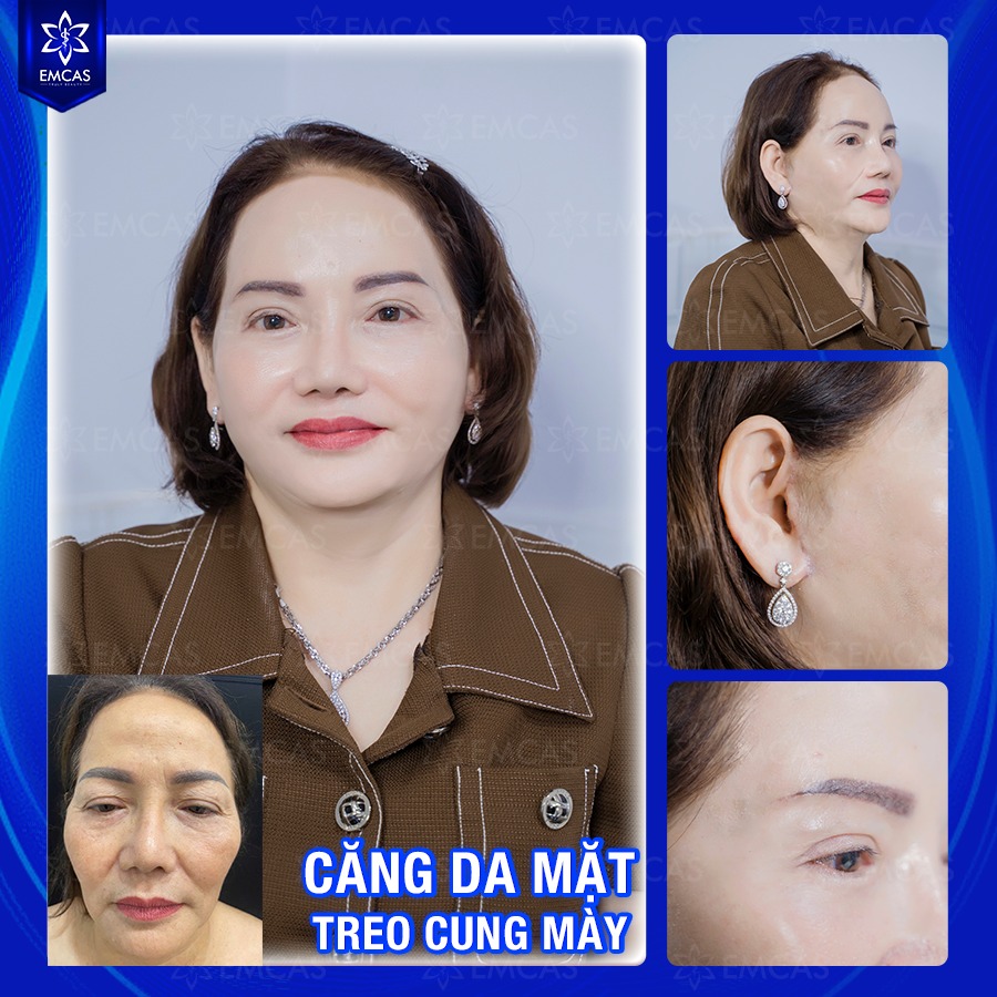 Một Số Câu Hỏi Về Dịch Vụ Căng Da Mặt
