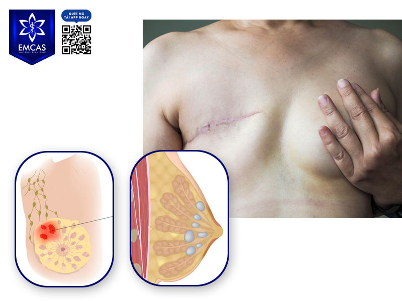 Hồi Sinh Tuyến Vú Sau Khi Điều Trị Ung Thư Vú