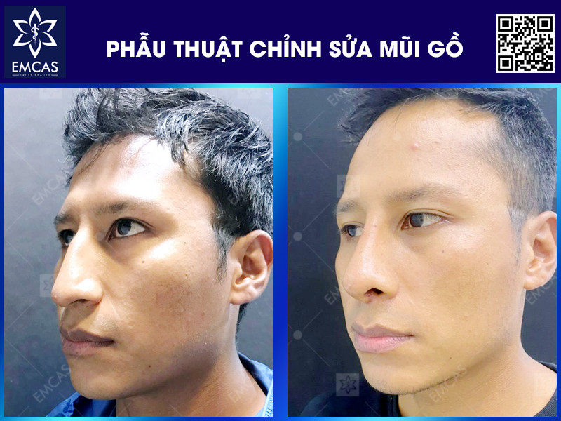 PHẪU THUẬT CHỈNH SỬA MŨI GỒ