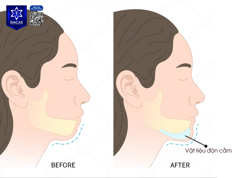 Tất Cả Những Điều Bạn Cần Biết Về Phẫu Thuật Độn Cằm
