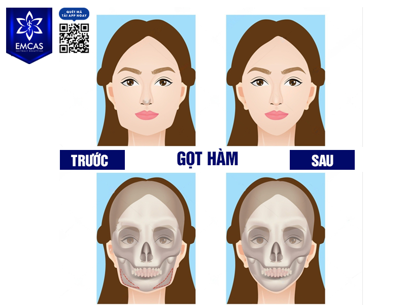 Gọt Hàm Có An Toàn Không?