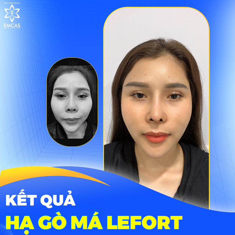 Hạ Gò Má Có Duy Trì Vĩnh Viễn Không?