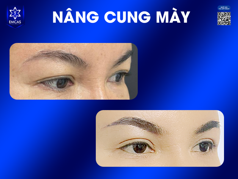Nâng Cung Chân Mày Có Tác Dụng Gì?
