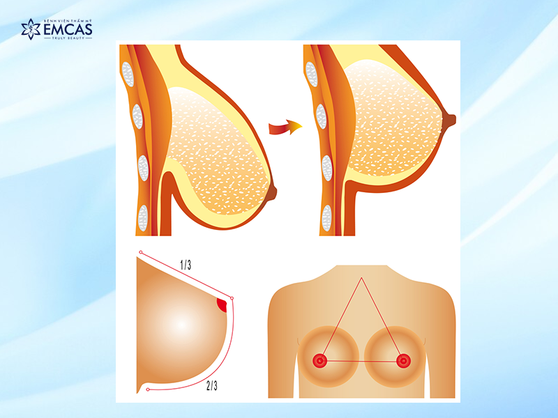 Có Nên Nâng Ngực Không? Những Điều Bạn Cần Biết