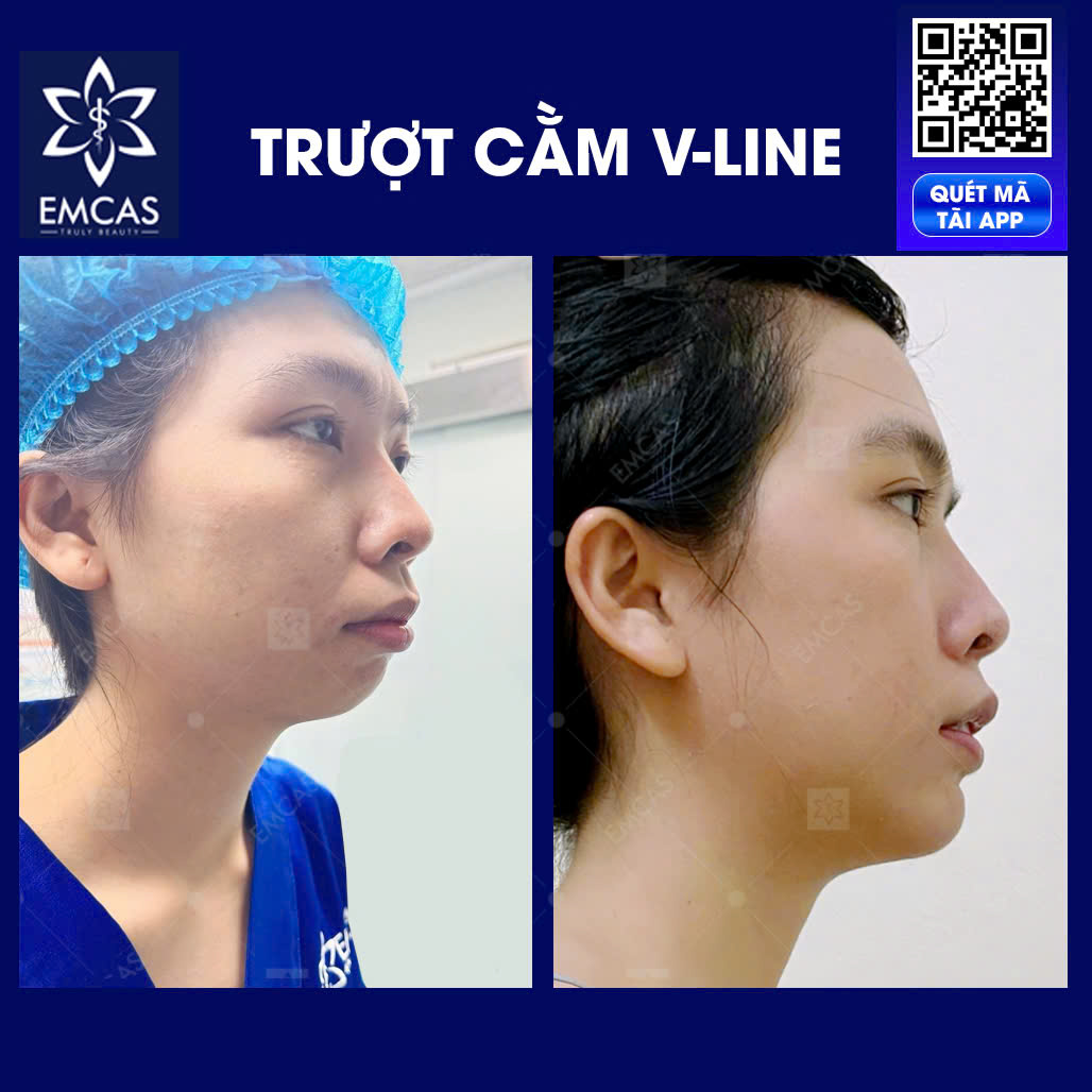 Cằm Đẹp V-Line Với Phương Pháp Trượt Cằm