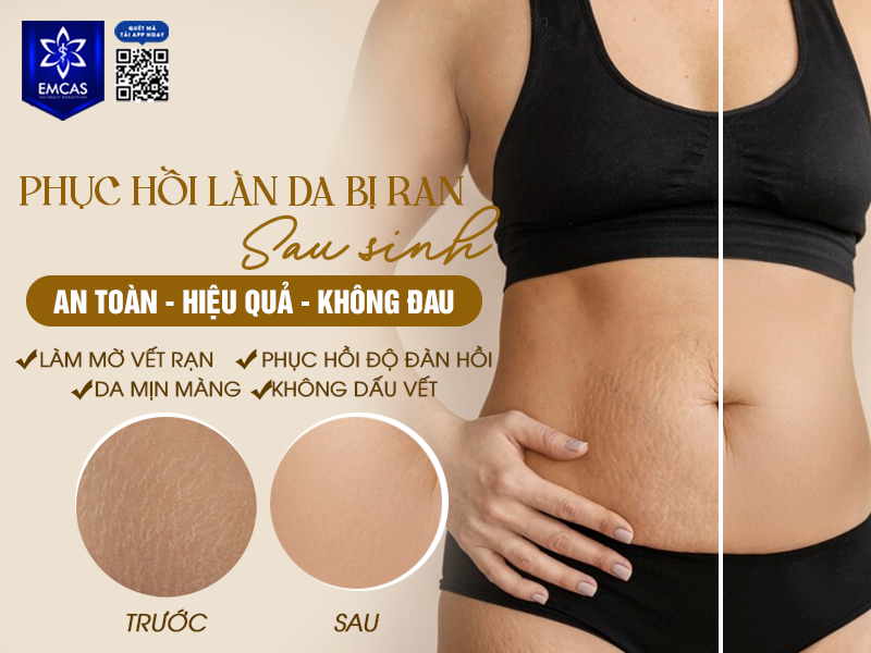 Phương Pháp Phục Hồi Làn Da Bị Rạn Sau Sinh