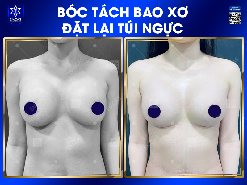 Khắc Phục Biến Chứng Bao Xơ Khi Nâng Ngực
