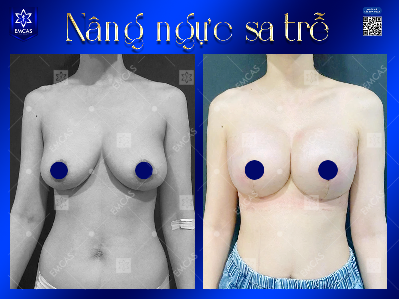 Khắc Phục Ngực Sa Trễ Sau Sinh