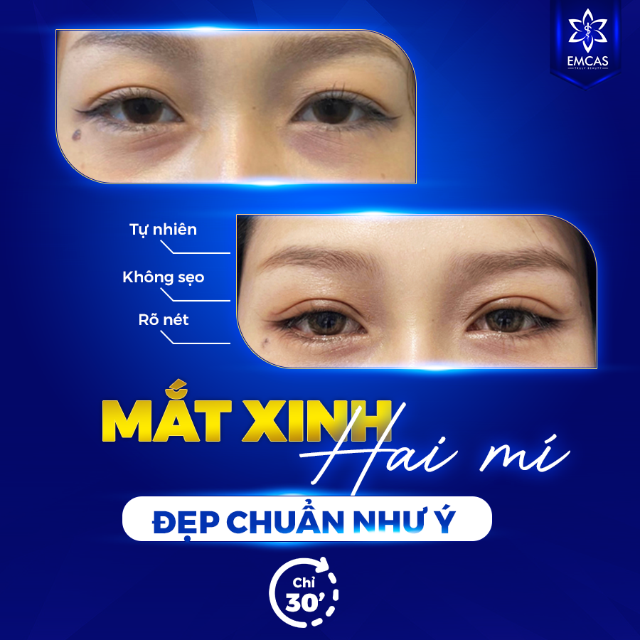 tạo mí đôi qua đường nếp mí