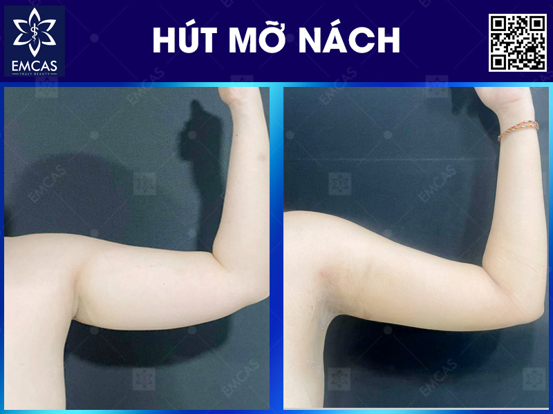 HÚT MỠ NÁCH
