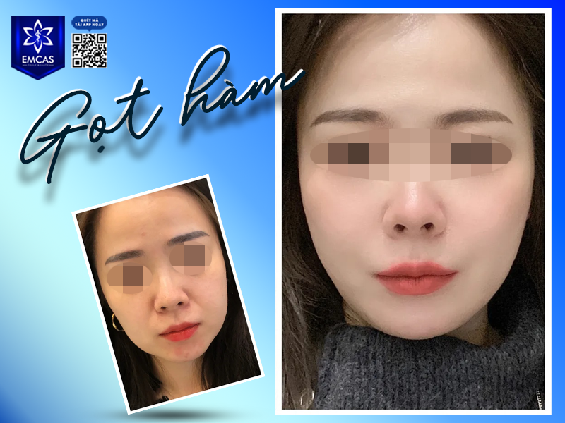Gọt Hàm Bao Lâu Thì Lành? Các Giai Đoạn Hồi Phục Bạn Cần Biết