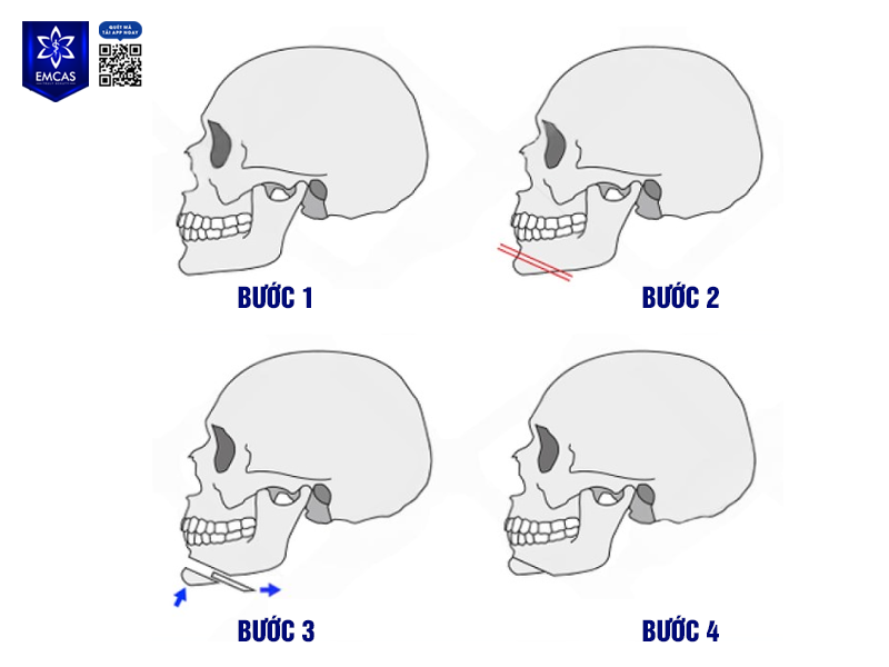 Trượt Cằm - Bí Quyết Sở Hữu Gương Mặt V-Line Hoàn Hảo