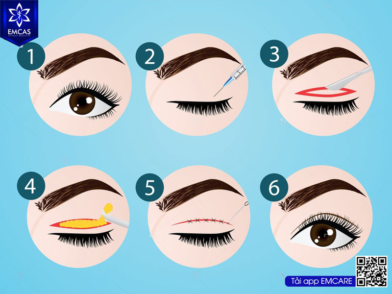Cắt Mí Mắt Có Đau Không? Những Lưu Ý Quan Trọng Sau Phẫu Thuật
