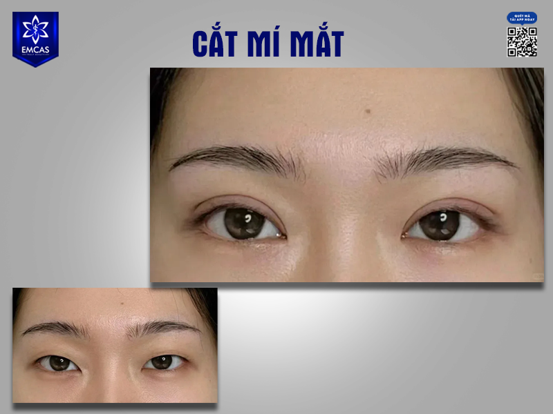 Quy trình thực hiện cắt mí