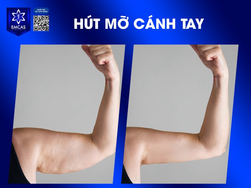 Hút Mỡ Bắp Tay - Phương Pháp Giúp Cánh Tay Săn Chắc, Không Chảy Xệ