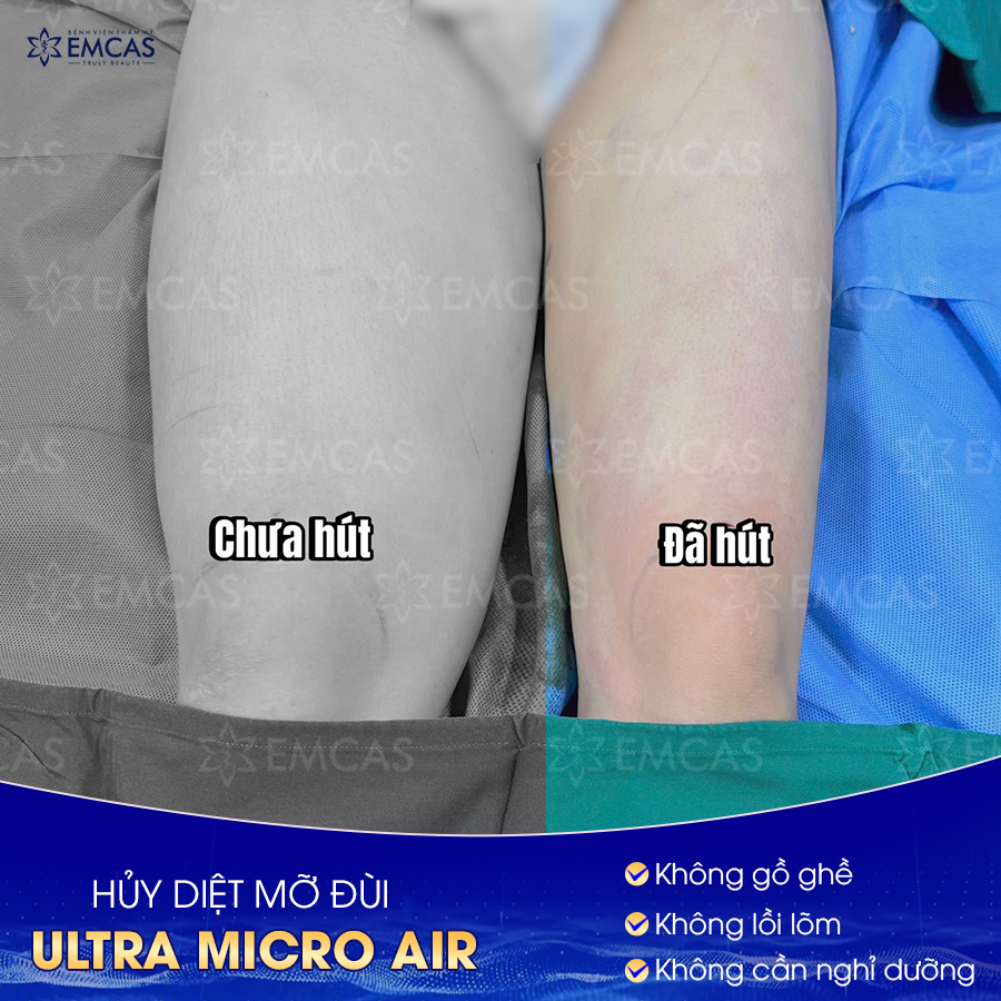 Lấy Lại Đôi Chân Thon Gọn Bằng Dịch Vụ Hút Mỡ Đùi