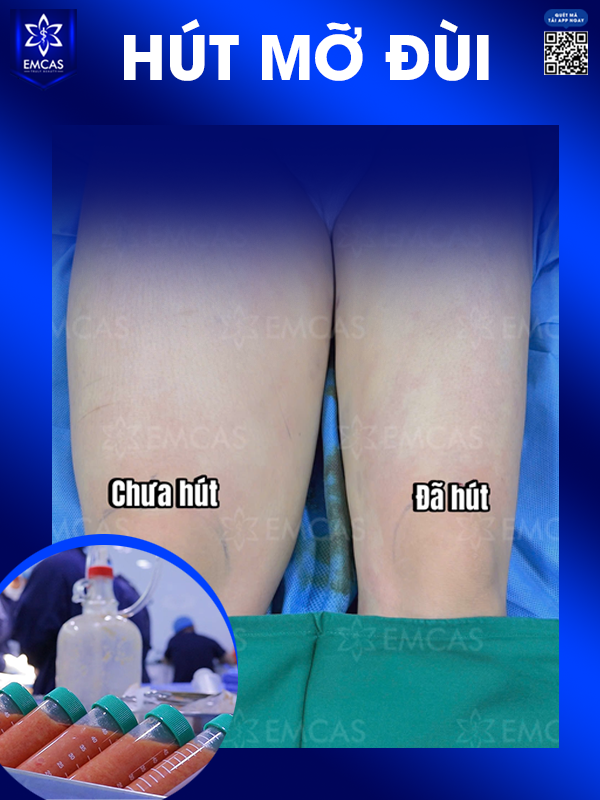 Hút Mỡ Đùi Có Giúp Đôi Chân Thon Gọn Không?