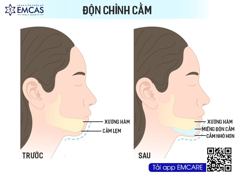 ĐỘN CHỈNH CẰM
