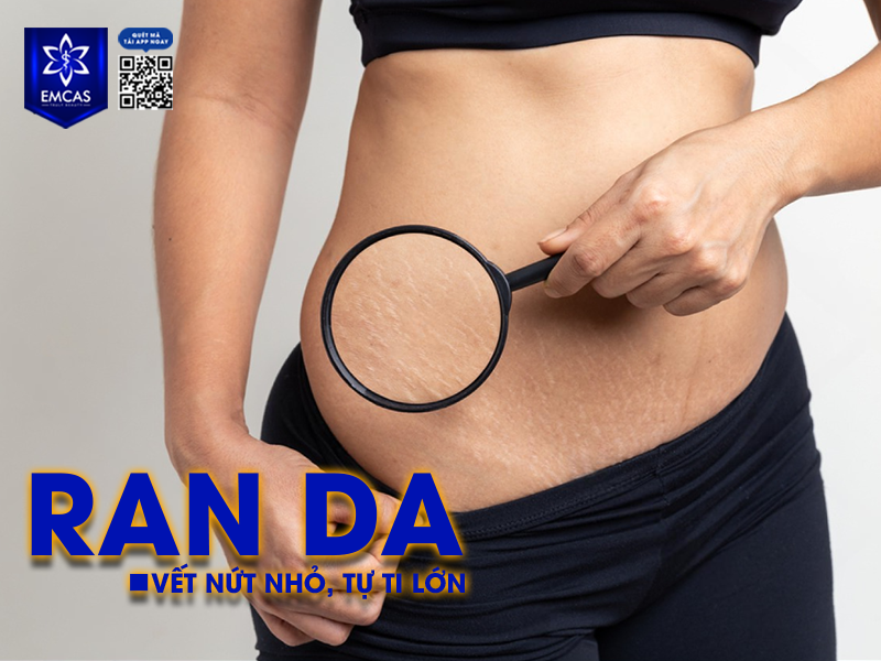 Rạn Da Có Ảnh Hưởng Gì Không?