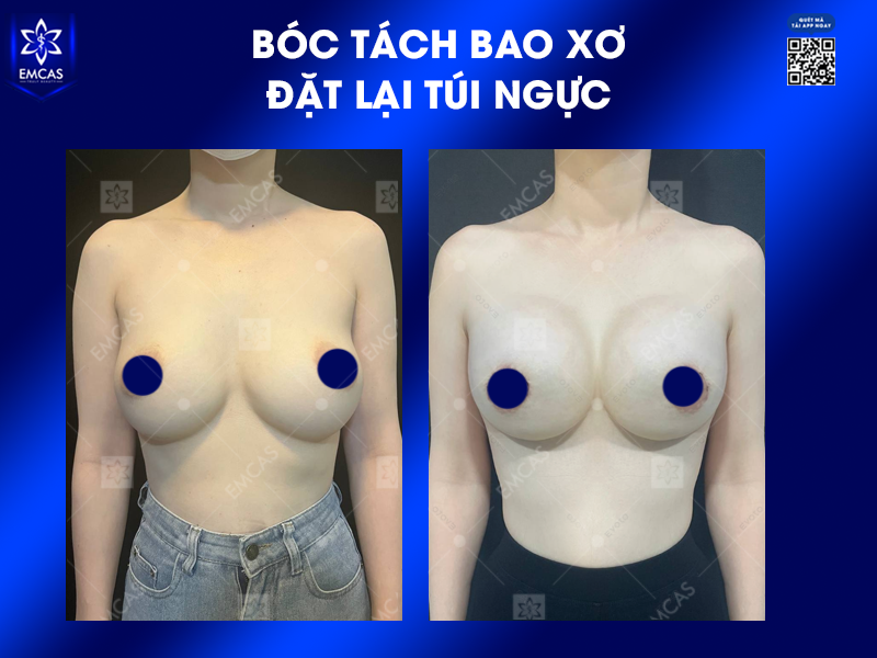 Thay Túi Ngực, Bóc Tách Bao Xơ – Xử Lý Biến Chứng, Làm Đẹp Lại Vòng 1