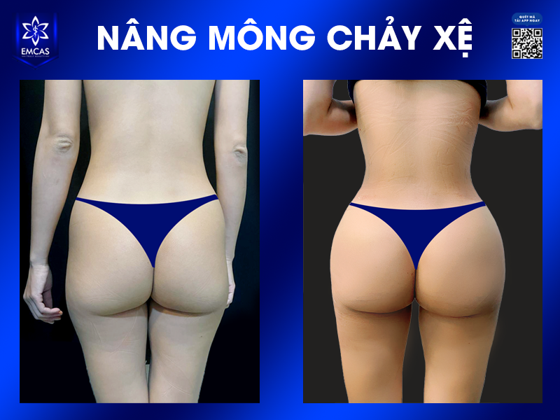 Sau Khi Nâng Mông Có Bị Chảy Xệ Không? Cách Duy Trì Vòng 3 Săn Chắc