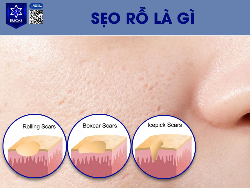 Sẹo Rỗ Là Gì? Nguyên Nhân Hình Thành Sẹo Rỗ?