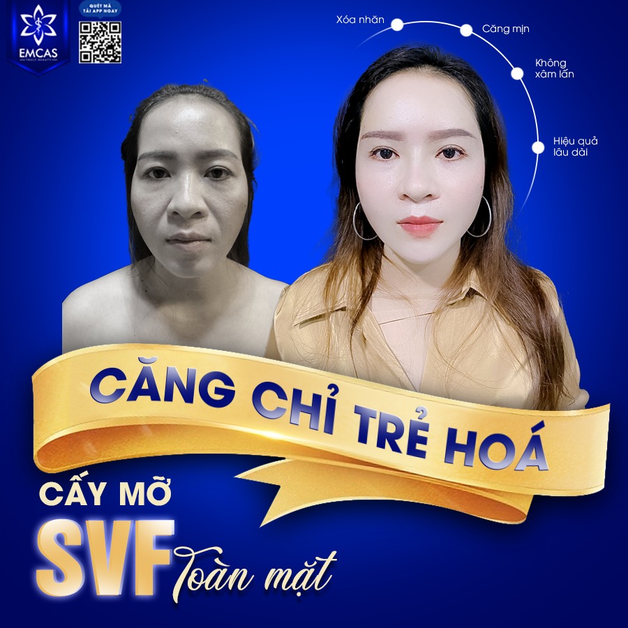 Làm Đẹp Khuôn Mặt An Toàn Bằng Mỡ Tự Thân