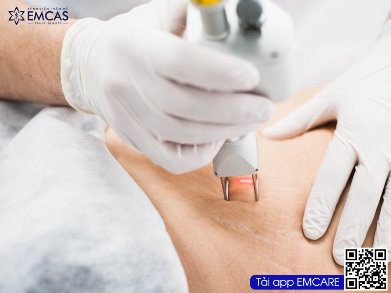 Điều trị rạn nứt da