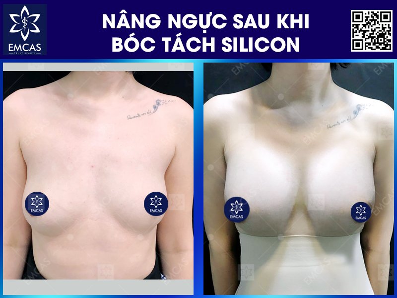 NÂNG NGỰC SAU KHI BÓC TÁCH SILICON