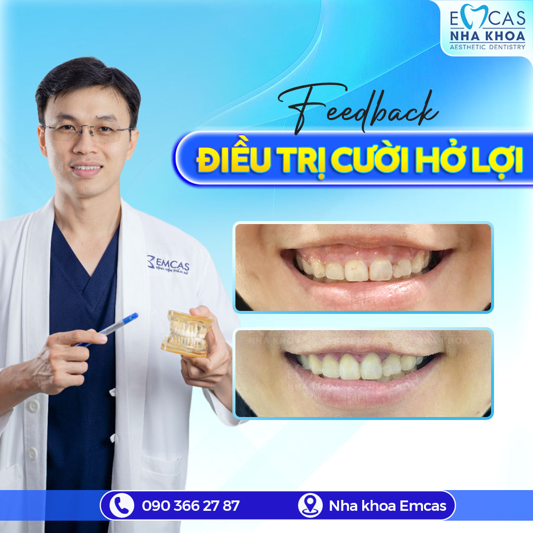 Điều Trị Cười Hở Lợi - Giải Pháp Giúp Bạn Sở Hữu Nụ Cười Tự Tin Hơn