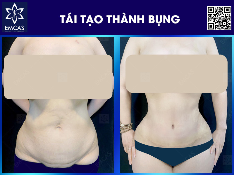 Tái tọa thành bụng