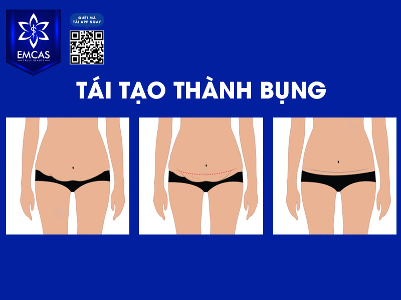 Tái Tạo Thành Bụng Có Ảnh Hưởng Đến Việc Mang Thai?