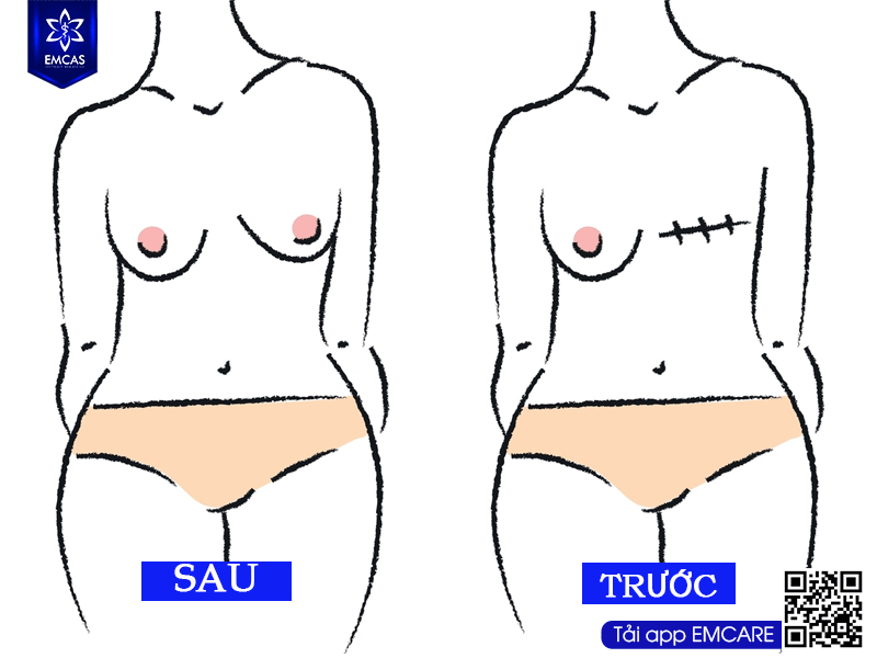 TÁI TẠO TUYẾN VÚ SAU UNG THƯ