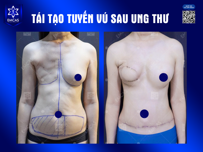 Tái Tạo Tuyến Vú Sau Ung Thư - Giải Pháp Giúp Phụ Nữ Lấy Lại Sự Tự Tin