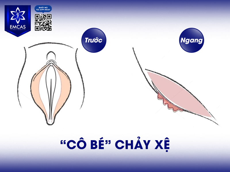 Một Số Lưu Ý Sau Khi Thẩm Mỹ Tầng Sinh Môn