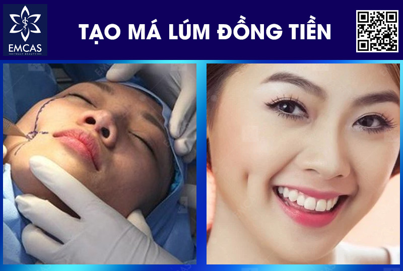 TẠO MÁ LÚM ĐỒNG TIỀN