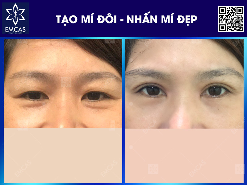 TẠO MÍ ĐÔI - NHẤN MÍ ĐẸP