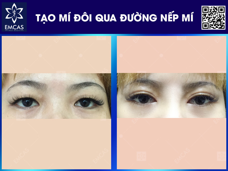 tạo mí đôi qua đường nếp mí