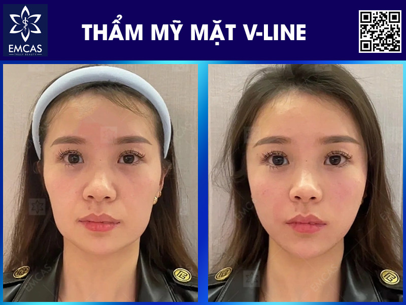 THẨM MỸ MẶT V-LINE