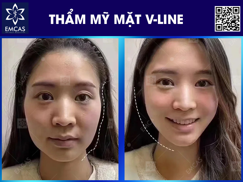 THẨM MỸ MẶT V-LINE