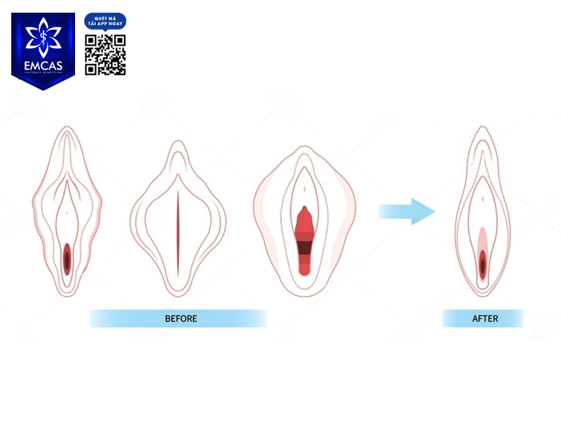 Một Số Lưu Ý Sau Khi Thẩm Mỹ Tầng Sinh Môn