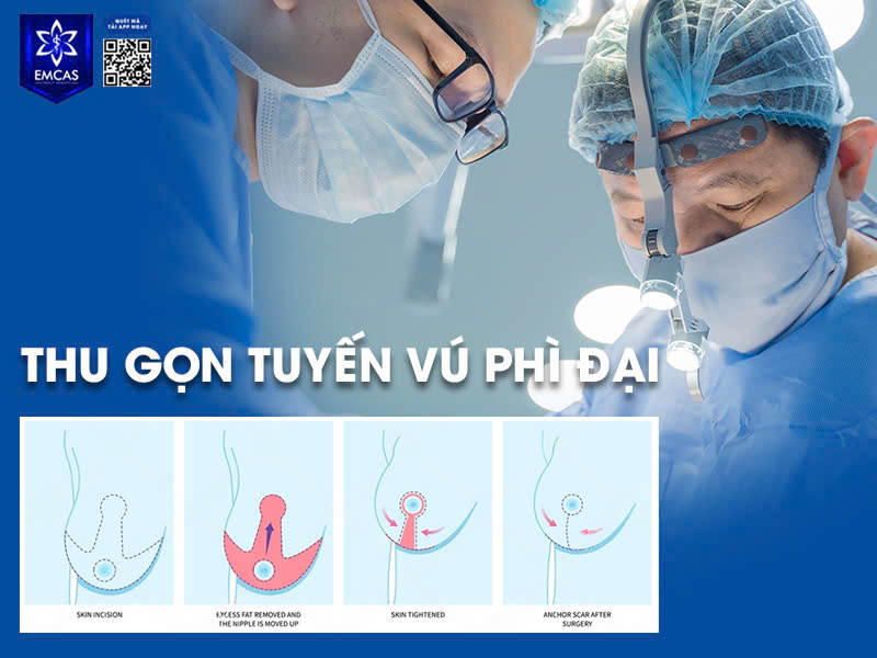 Nguyên Nhân Và Cách Điều Trị Tuyến Vú Phì Đại Hiệu Quả