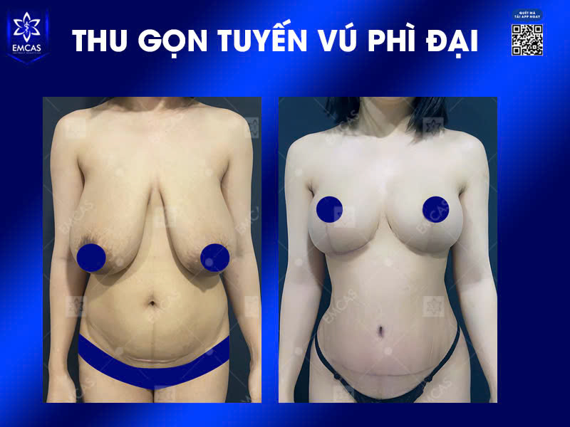 Nguyên Nhân Và Cách Điều Trị Tuyến Vú Phì Đại Hiệu Quả